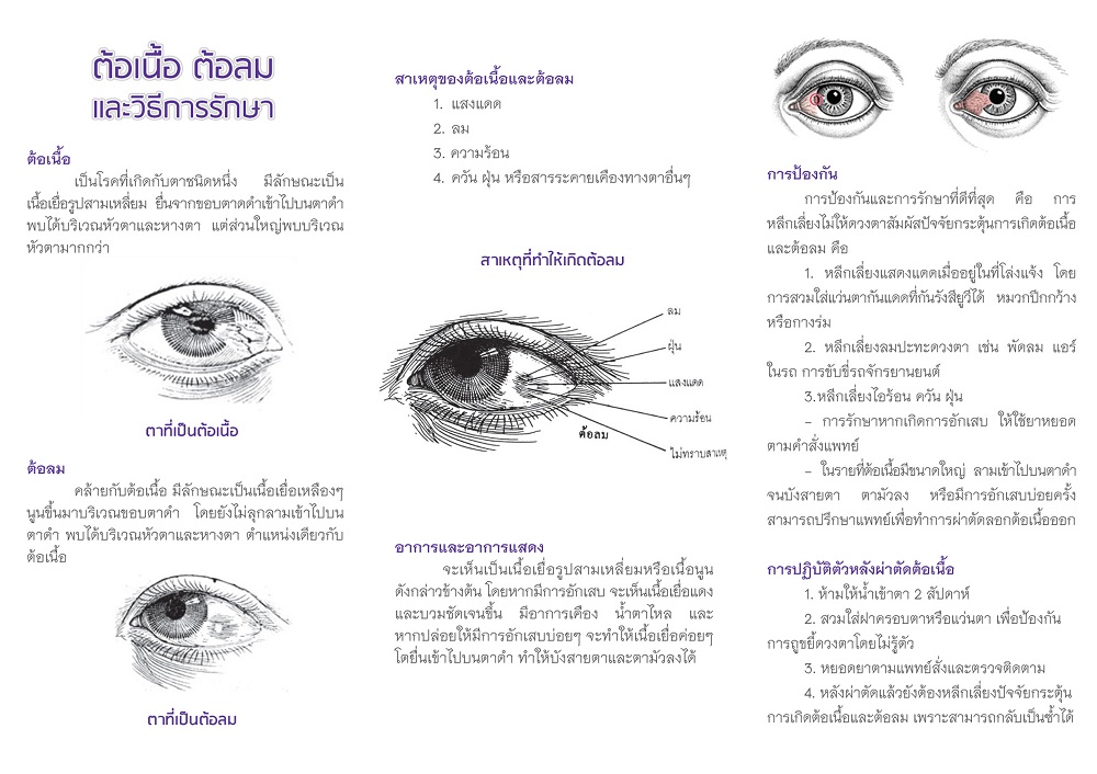 ต้อลม_ต้อเนื้อ1